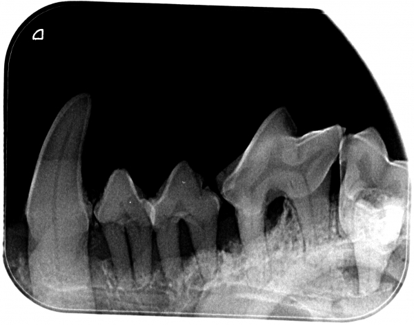 severe horizontal bone loss around roots